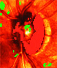 Heidelberg Retinal Tomograph