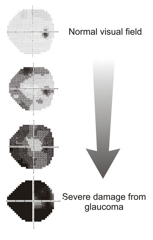 What Is A Visual Field Test Glaucoma Cataract Prof Eytan Blumenthal